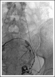 Fibroid Embolisation X-ray Oxford Interventional Radiology